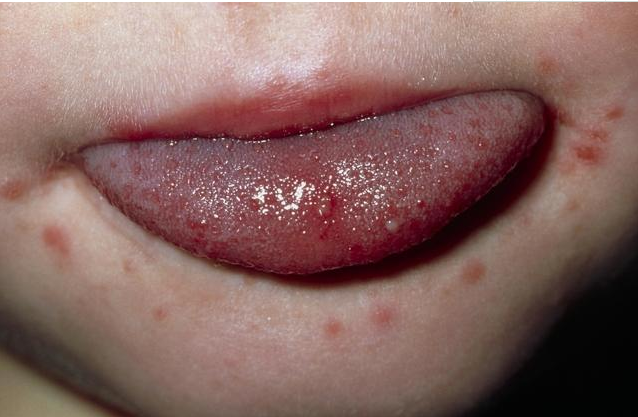 手足口病不吃藥能治愈嗎 同一名兒童會多次感染手足口病嗎