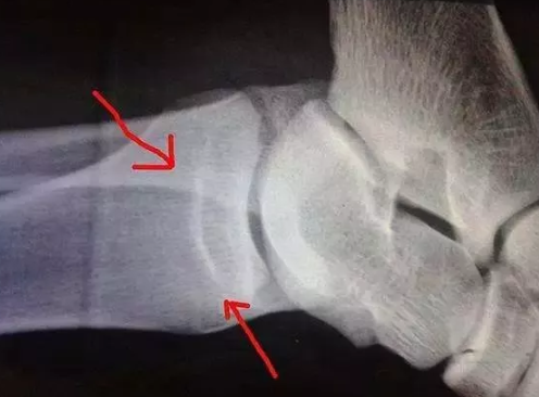 骨骺線什么時候閉合 預防骨骺線閉合的方法