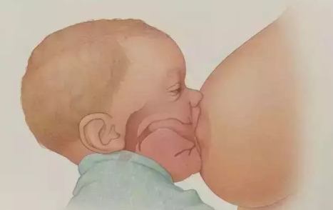 怎么預防產后乳腺炎 預防產后乳腺炎膿腫