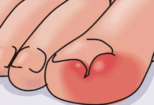 寶寶腳指甲往肉里長怎么回事 指甲往肉里長的原因