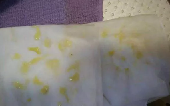 斷奶后不排殘奶容易得癌癥嗎 斷奶后不排殘奶有哪些影響