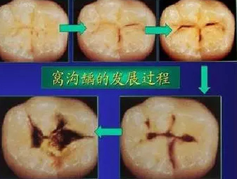 后槽牙上的黑線是沒刷干凈嗎 窩齲該怎么預防 后槽牙上的黑線是沒刷干凈嗎 窩齲該怎么預防