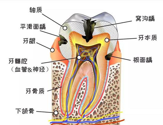 后槽牙上的黑線是沒刷干凈嗎 窩齲該怎么預防 后槽牙上的黑線是沒刷干凈嗎 窩齲該怎么預防