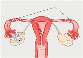輸卵管積液做腹腔鏡了懷孕率還是低嗎 輸卵管積液處理方法