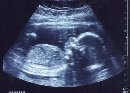 孕酮低是先兆流產的指標嗎 孕酮數值可作為流產依據嗎 孕酮低是先兆流產的指標嗎 孕酮數值可作為流產依據嗎