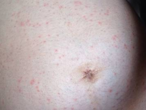 懷孕妊娠皰疹什么癥狀 妊娠皰疹對胎兒有什么影響