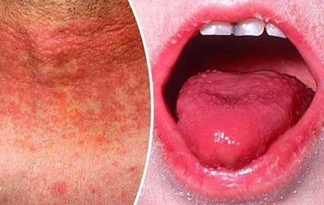 如何區(qū)分麻疹、風(fēng)疹、猩紅熱 麻疹、風(fēng)疹、猩紅熱相同點(diǎn)和不同點(diǎn)