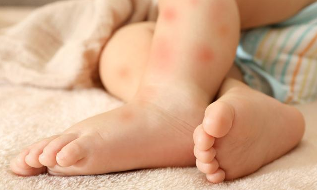 如何區(qū)分麻疹、風(fēng)疹、猩紅熱 麻疹、風(fēng)疹、猩紅熱相同點(diǎn)和不同點(diǎn)