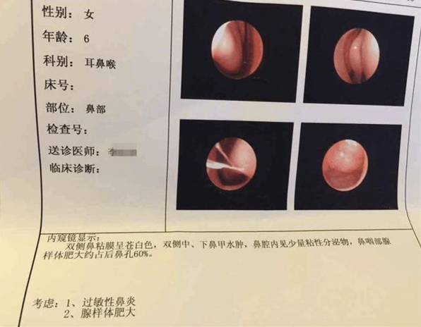 孩子腺樣體肥大和過敏有關(guān)系嗎 孩子腺樣體肥大如何調(diào)理 孩子腺樣體肥大和過敏有關(guān)系嗎 孩子腺樣體肥大如何調(diào)理