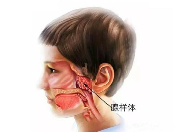 孩子腺樣體肥大和過敏有關(guān)系嗎 孩子腺樣體肥大如何調(diào)理 孩子腺樣體肥大和過敏有關(guān)系嗎 孩子腺樣體肥大如何調(diào)理
