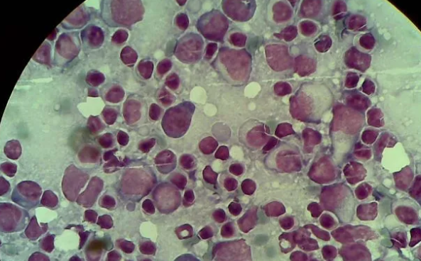 單純皰疹感染還能懷孕嗎 妊娠期感染HSV怎么辦