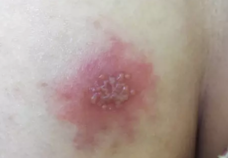 單純皰疹感染還能懷孕嗎 妊娠期感染HSV怎么辦