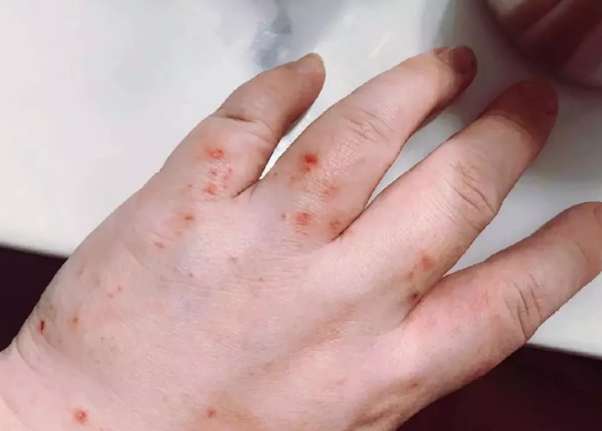 妊娠皰疹和丘疹蕁麻疹區(qū)別 妊娠瘙癢性蕁麻疹怎么治療