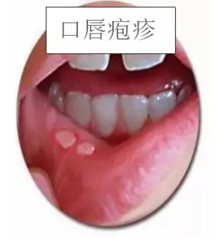 妊娠皰疹是什么引起的 單純皰疹病毒對孕婦的影響 妊娠皰疹是什么引起的 單純皰疹病毒對孕婦的影響