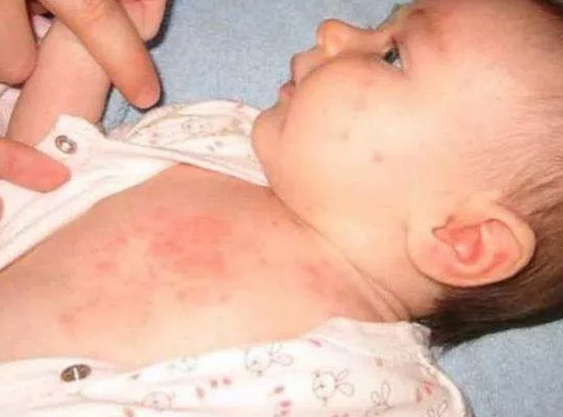 天氣炎熱如何預(yù)防寶寶長痱子 寶寶長了痱子怎么辦 天氣炎熱如何預(yù)防寶寶長痱子 寶寶長了痱子怎么辦