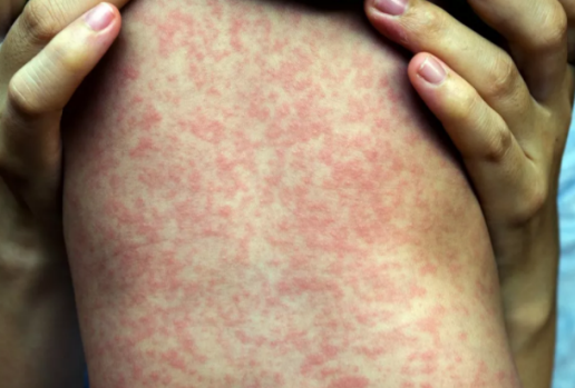 小兒麻疹如何護(hù)理 小兒麻疹的護(hù)理方法