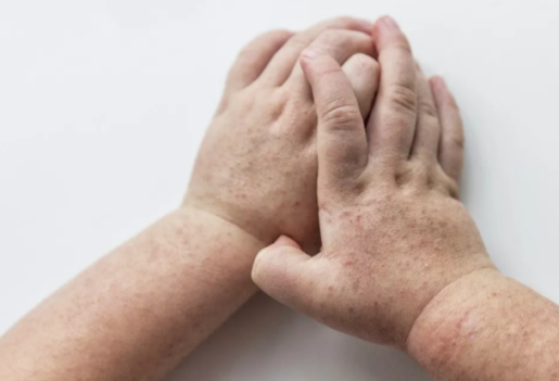 小兒麻疹如何護(hù)理 小兒麻疹的護(hù)理方法