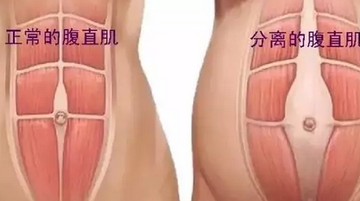 為什么產后肚子還是收不回來 什么是產后腹直肌分離 為什么產后肚子還是收不回來 什么是產后腹直肌分離