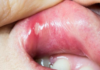 兒童口腔潰瘍和便秘有關(guān)嗎 導致兒童口腔潰瘍的因素