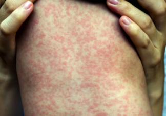 小兒麻疹如何護理 小兒麻疹的護理方法