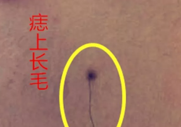 孩子長了有毛的痣怎么辦 孩子長了有毛的痣可以去掉嗎