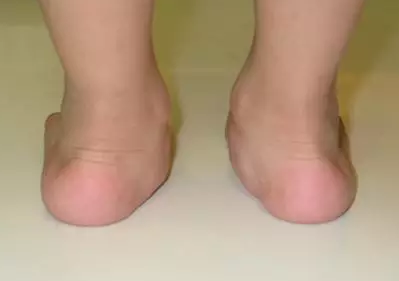 扁平足有什么危害 扁平足需要治療嗎