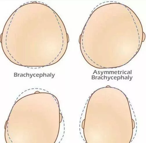 寶寶的頭多大會定型 寶寶頭型要怎么去睡 寶寶的頭多大會定型 寶寶頭型要怎么去睡