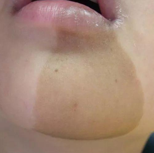 寶寶臉上長的老年斑是咖啡斑嗎 寶寶幾歲能做咖啡斑激光治療 寶寶臉上長的老年斑是咖啡斑嗎 寶寶幾歲能做咖啡斑激光治療