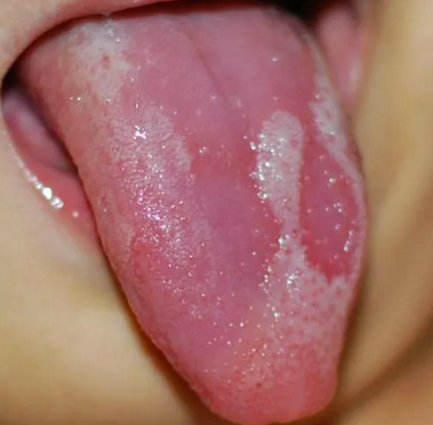 孩子積食和地圖舌有什么聯(lián)系 孩子地圖舌是因?yàn)榉e食嗎