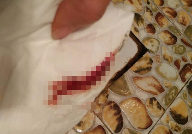 早孕出血正常嗎 懷孕初期出血的原因