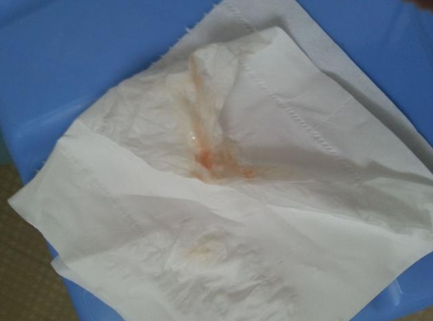 早孕出血正常嗎 懷孕初期出血的原因