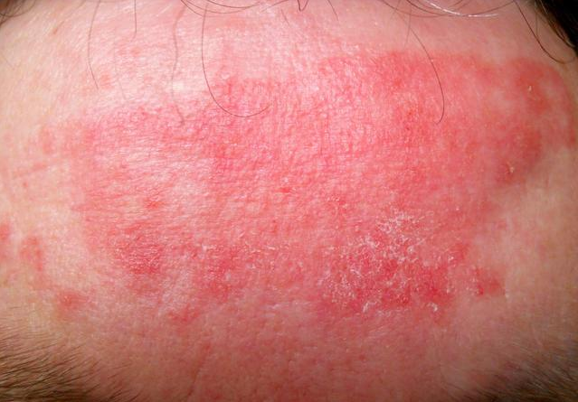 假性濕疣是什么 怎么區分假性濕疣和尖銳濕疣