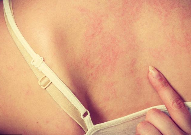 假性濕疣是什么 怎么區分假性濕疣和尖銳濕疣