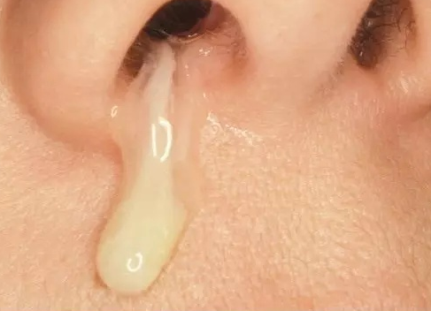 清鼻涕黃鼻涕顏色不同是為什么 清鼻涕黃鼻涕的區別 清鼻涕黃鼻涕顏色不同是為什么 清鼻涕黃鼻涕的區別