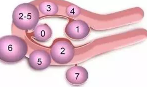 有子宮肌瘤想生娃要手術嗎 有子宮肌瘤想生娃怎么手術