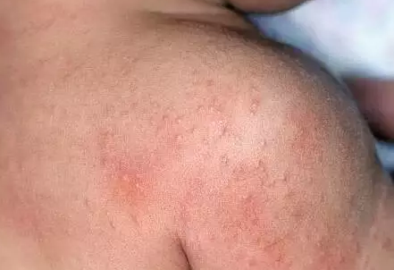 寶寶濕疹和痱子有什么區別 如何護理寶寶的痱子和濕疹