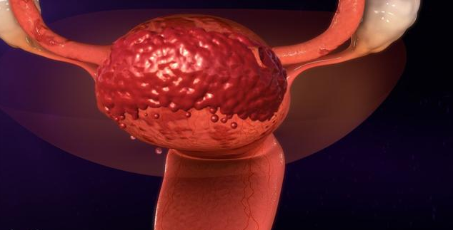 子宮內膜增厚會引發癌癥嗎 發現子宮內膜增厚怎么辦