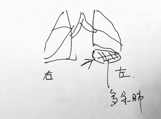 七歲男孩反復肺炎經檢查多長了一個肺 胎兒隔離肺診斷 七歲男孩反復肺炎經檢查多長了一個肺 胎兒隔離肺診斷