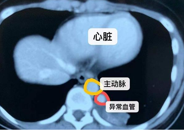 七歲男孩反復肺炎經檢查多長了一個肺 胎兒隔離肺診斷 七歲男孩反復肺炎經檢查多長了一個肺 胎兒隔離肺診斷