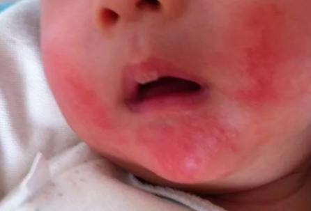 天氣濕熱怎么預防小兒濕疹 小兒濕疹怎么護理 天氣濕熱怎么預防小兒濕疹 小兒濕疹怎么護理