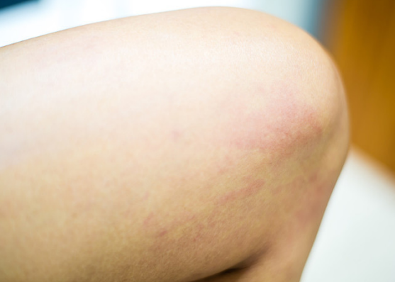 孩子過敏體質(zhì)的原因 這些事情家長不要做 孩子過敏體質(zhì)的原因 這些事情家長不要做