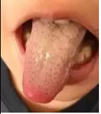 孩子舌苔白、厚、膩怎么推拿 孩子舌苔厚推拿手法