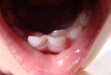 兒童乳牙壞了要拔掉嗎 兒童能拔牙嗎