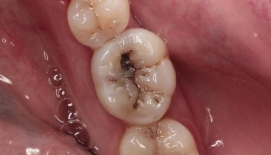 兒童乳牙壞了要拔掉嗎 兒童能拔牙嗎