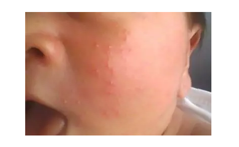 為什么現在孩子特別容易長濕疹 孩子長濕疹的原因是什么