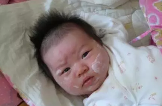 寶寶濕疹能用爐甘石洗劑嗎 寶寶用爐甘石洗劑后需要清洗嗎