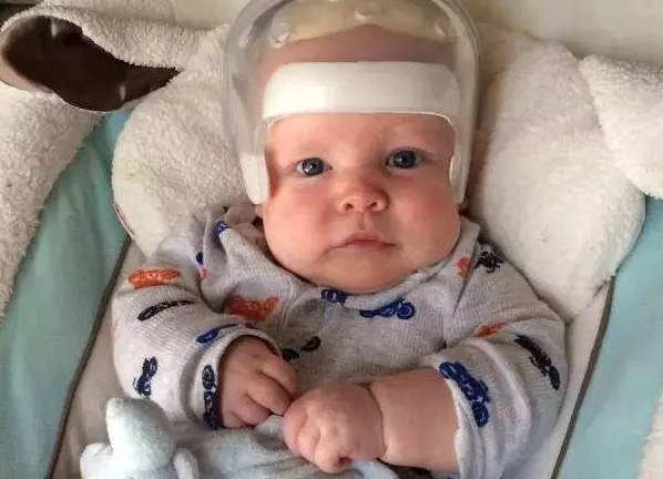 寶寶矯正頭盔需要帶多久 寶寶經常帶矯正頭盔累不累 寶寶矯正頭盔需要帶多久 寶寶經常帶矯正頭盔累不累