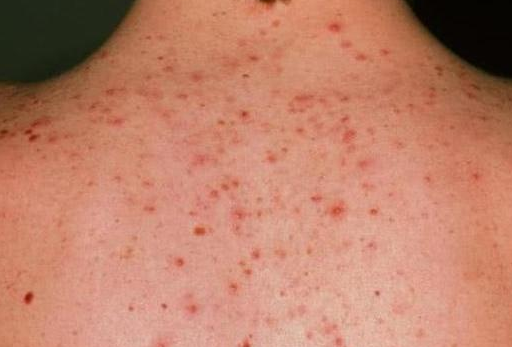 后背長痘是螨蟲嗎 后背上長痘了該怎么辦 后背長痘是螨蟲嗎 后背上長痘了該怎么辦