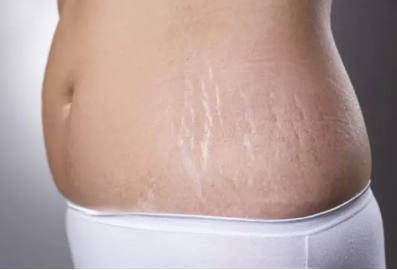 為什么女性懷孕會出現妊娠紋 妊娠紋怎怎么去除