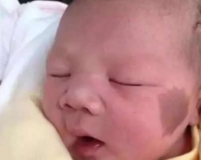 寶寶出生胎記和媽媽有關嗎 如何預防寶寶長胎記